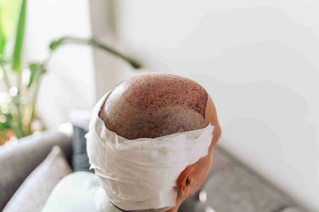 Haartransplantation woher Haare