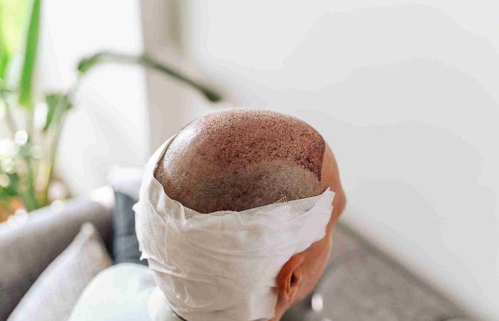 Haartransplantation: woher Haare? Spenderbereiche im Überblick 9 Haartransplantation woher Haare