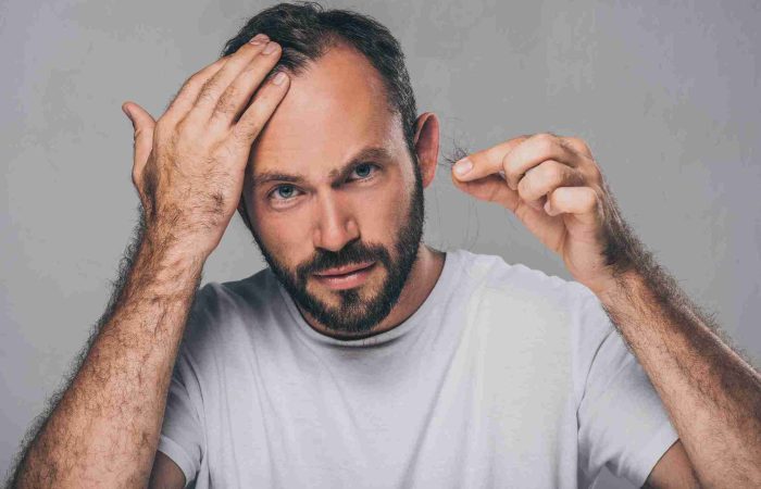 Ab welchem Alter Haartransplantation – Eine Frage des Timings 8 Mann mit Haarausfall