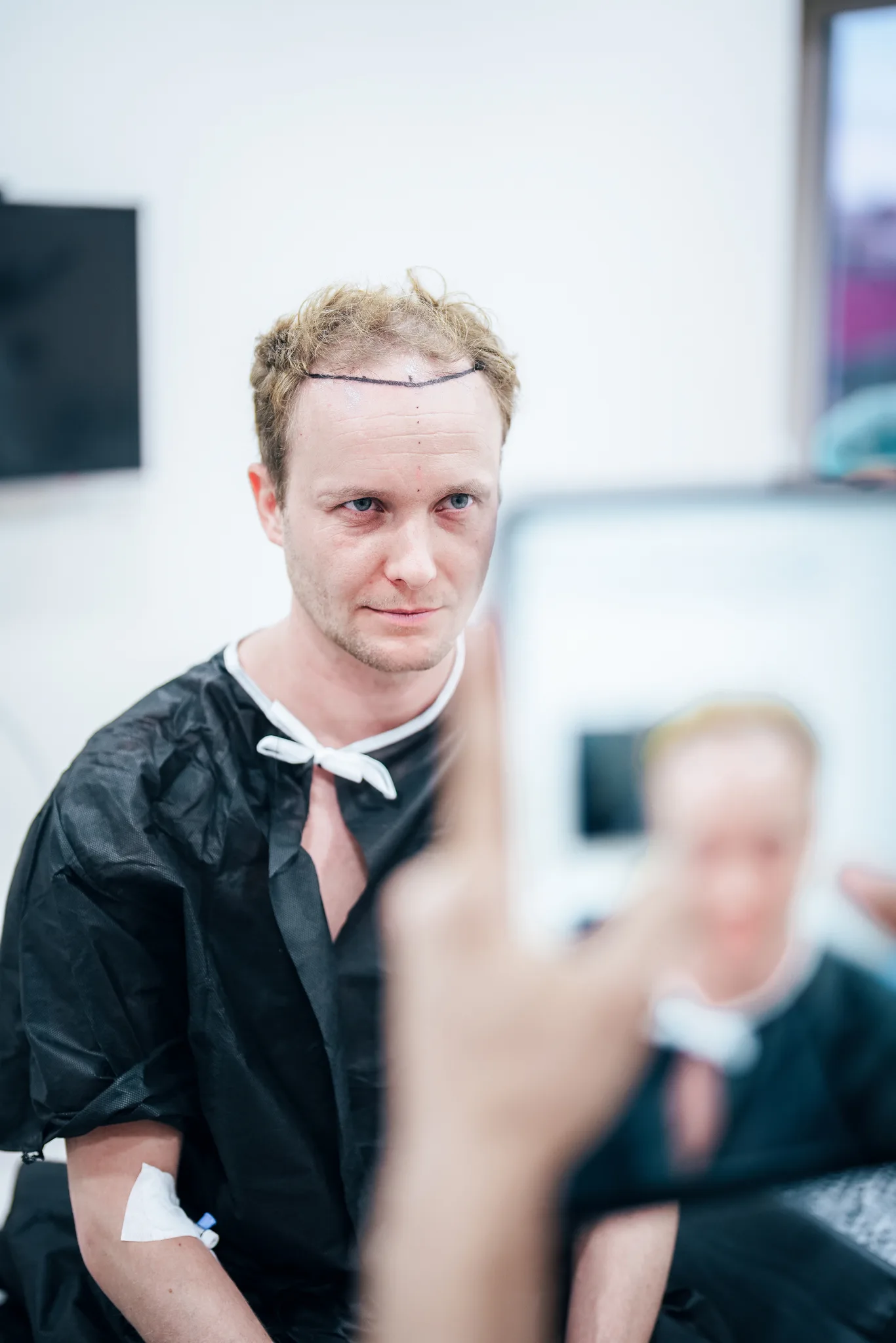 Before After Hair Transplant