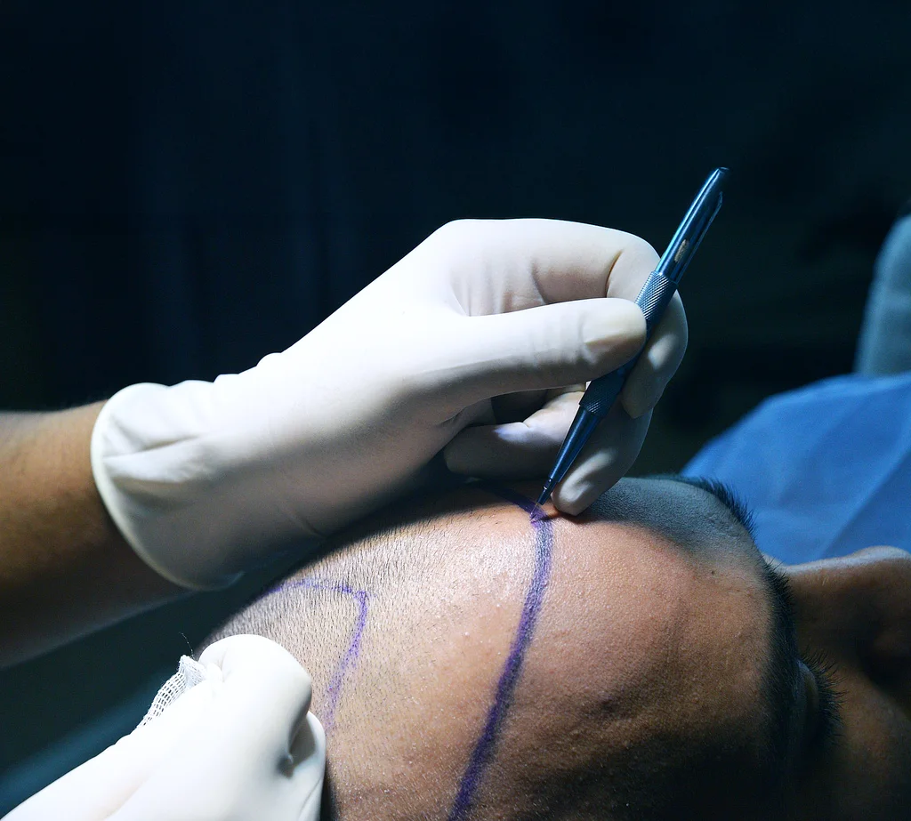 Surgeon drawing the new hairline on a patient's forehead before a Sapphire FUE hair transplant