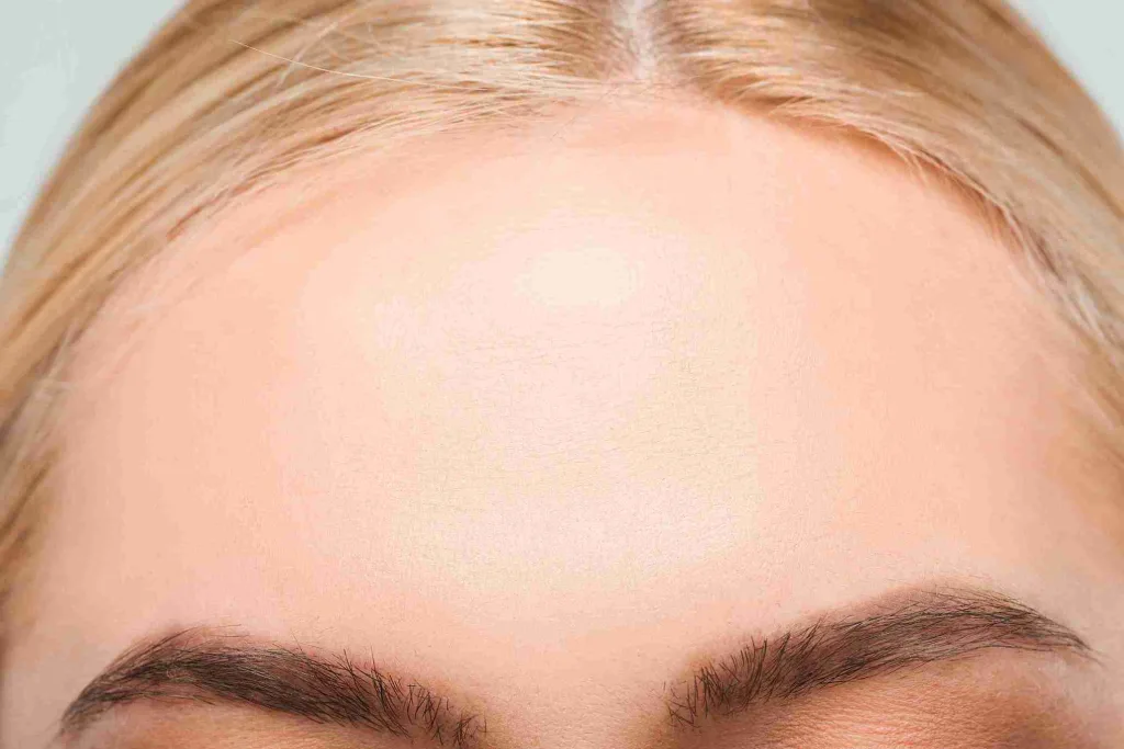 Stirn einer Frau veranschaulicht die Haarlinienkorrektur