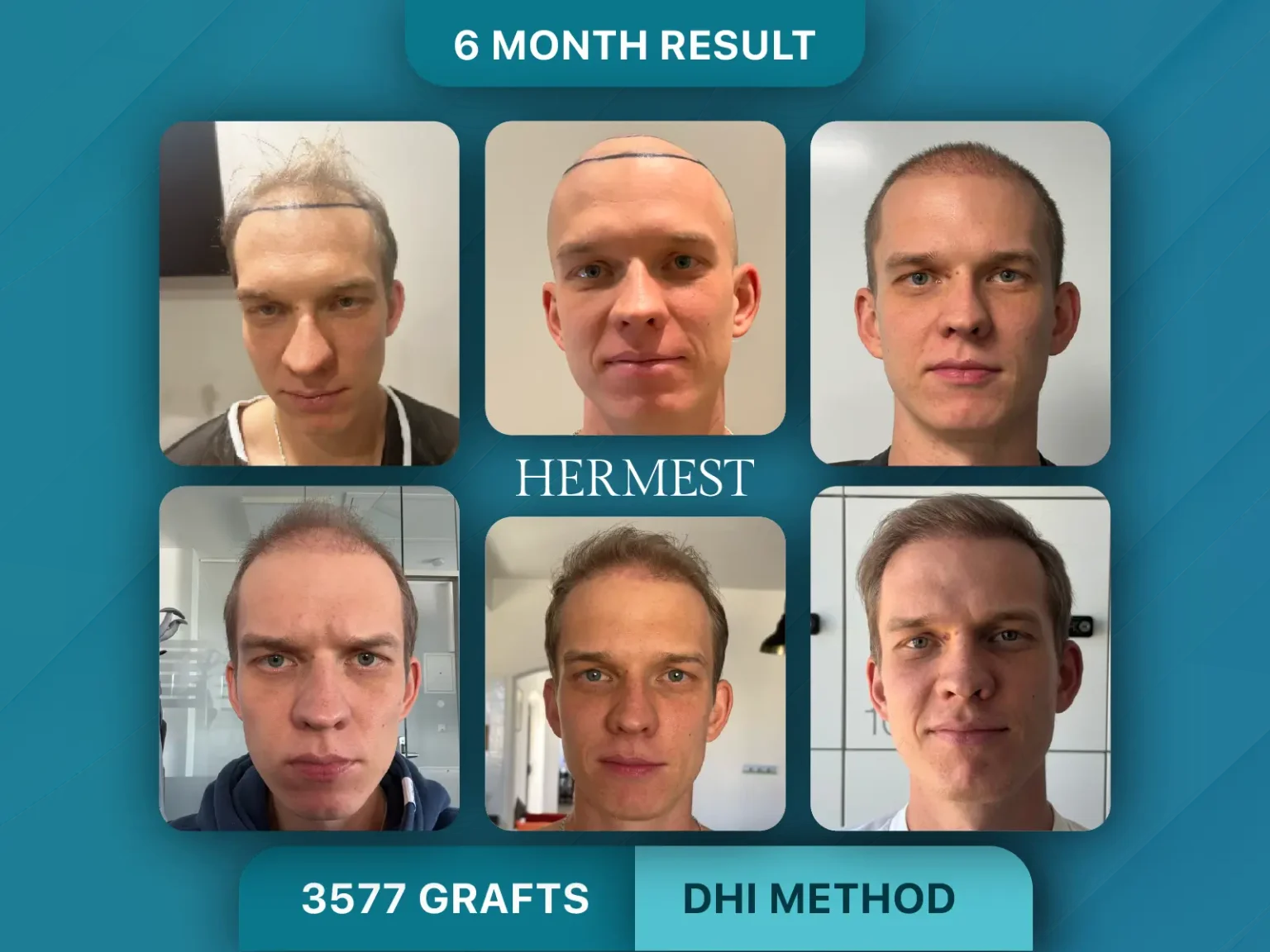 Hair Transplant Before After 3577 Grafts