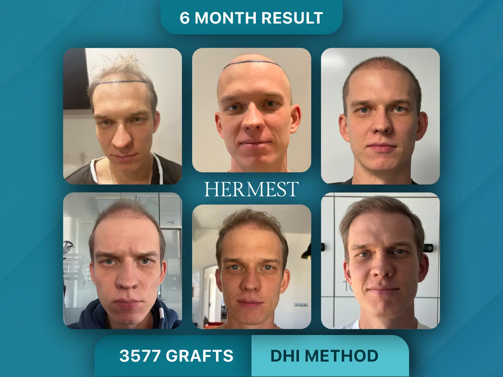 The Advantages and Disadvantages of Hair Transplants: Full Guide 9 Hair Transplant Before After 3577 Grafts