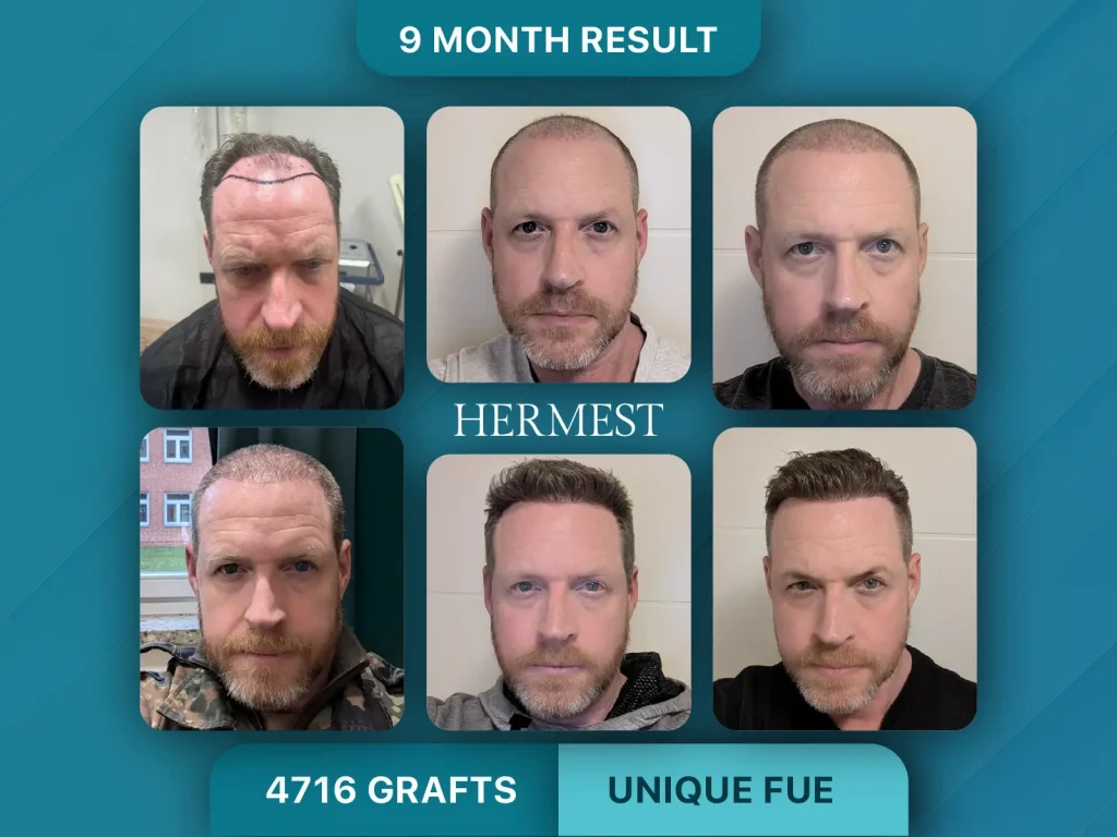Hair Transplant Before After 4176 Grafts