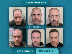 DHI vs FUE Hair Transplant: Which Is Better? 5 Hair Transplant Before After 4176 Grafts