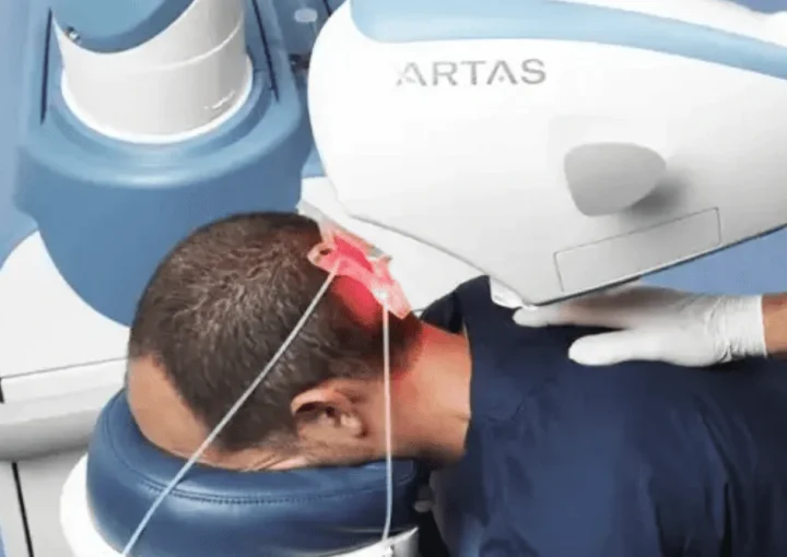 artas robotic hair transplant