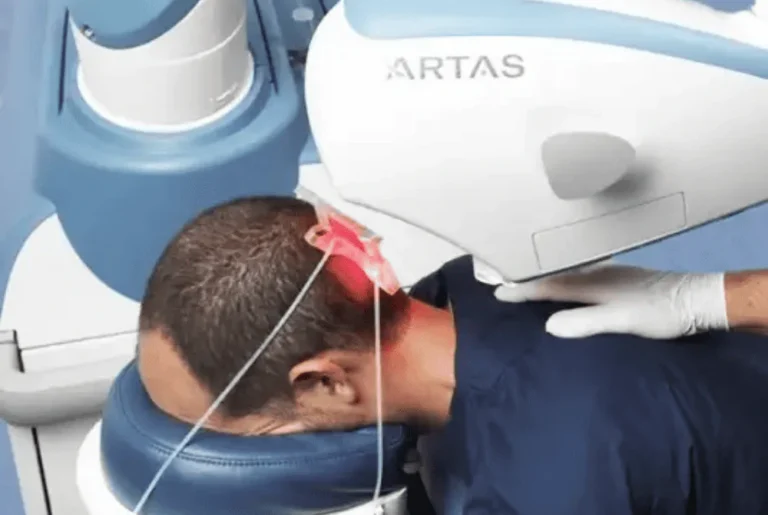 artas robotic hair transplant
