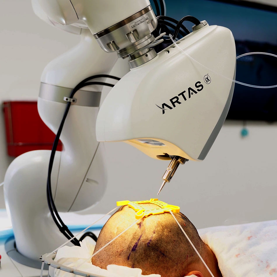Robotic Hair Transplant in Turkey: Is the Hype Real or Just Marketing 4 artas robotic hair transplants