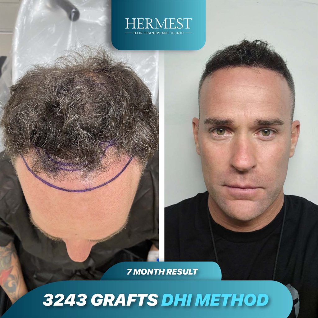 Before and after hair transplant image demonstrating the transformation achieved with 3,243 grafts.