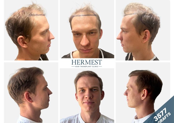 3500 Grafts Hair Transplant: Cost, Coverage & Recovery 7 Before and after hair transplant photo showing the results of 3,500 grafts.