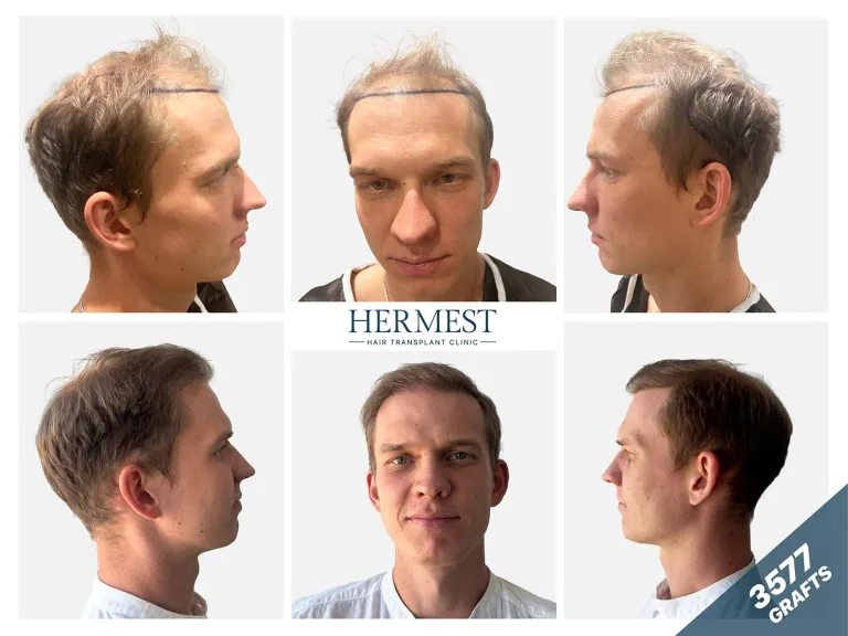 Before and after hair transplant photo showing the results of 3,500 grafts.