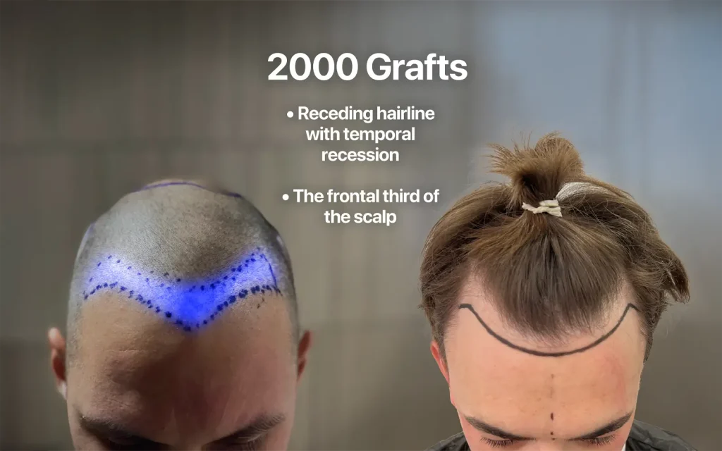 Illustration showing how much scalp area can be covered with 2000 grafts in a hair transplant procedure