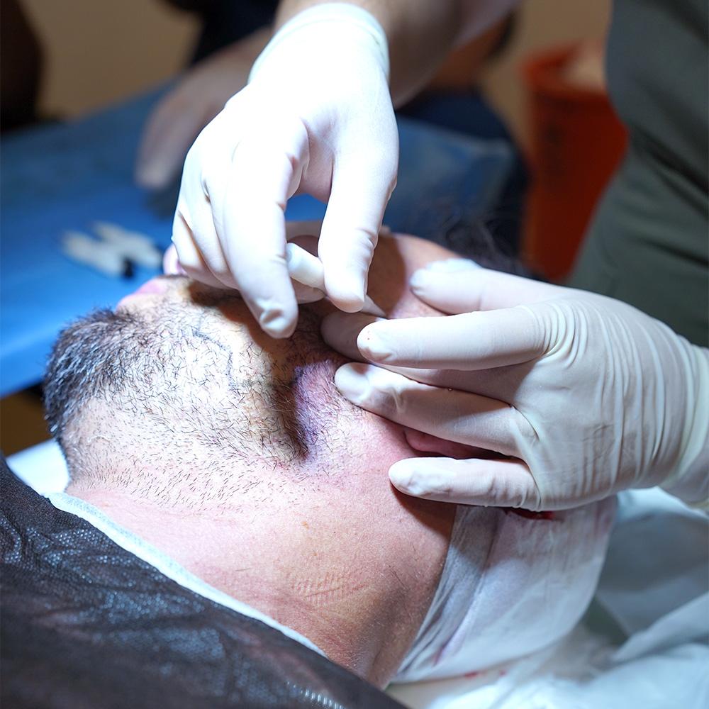 Barttransplantation wahrend der OP