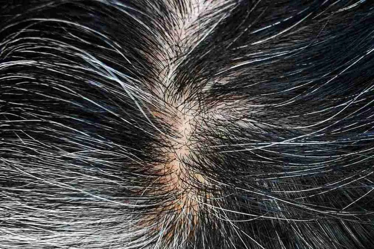 Nahaufnahme einer Kopfhaut. Artikelbild zum Thema Haarwurzeln aktivieren.