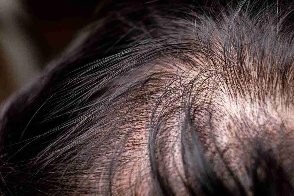 Nahaufnahme einer Kopfhaut mit lichter werdendem Haar, die den Zusammenhang zwischen Haarausfall und Haarzyklus verdeutlicht.