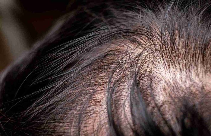 Der Haarzyklus – eine Einführung in die Wachstumsphasen 16 Nahaufnahme einer Kopfhaut mit lichter werdendem Haar, die den Zusammenhang zwischen Haarausfall und Haarzyklus verdeutlicht.