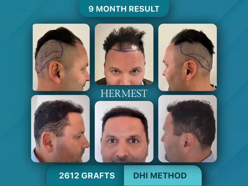 Hair Transplant Before After 2612 Graft