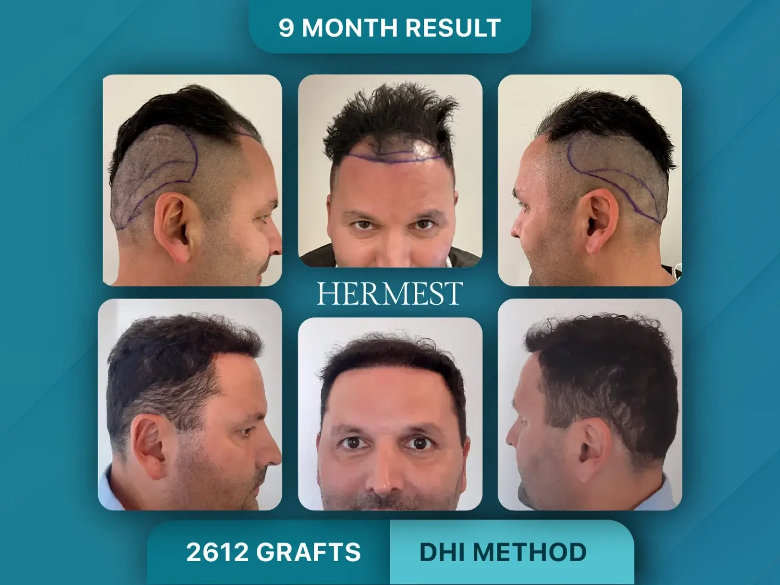 Hair Transplant Before After 2612 Graft