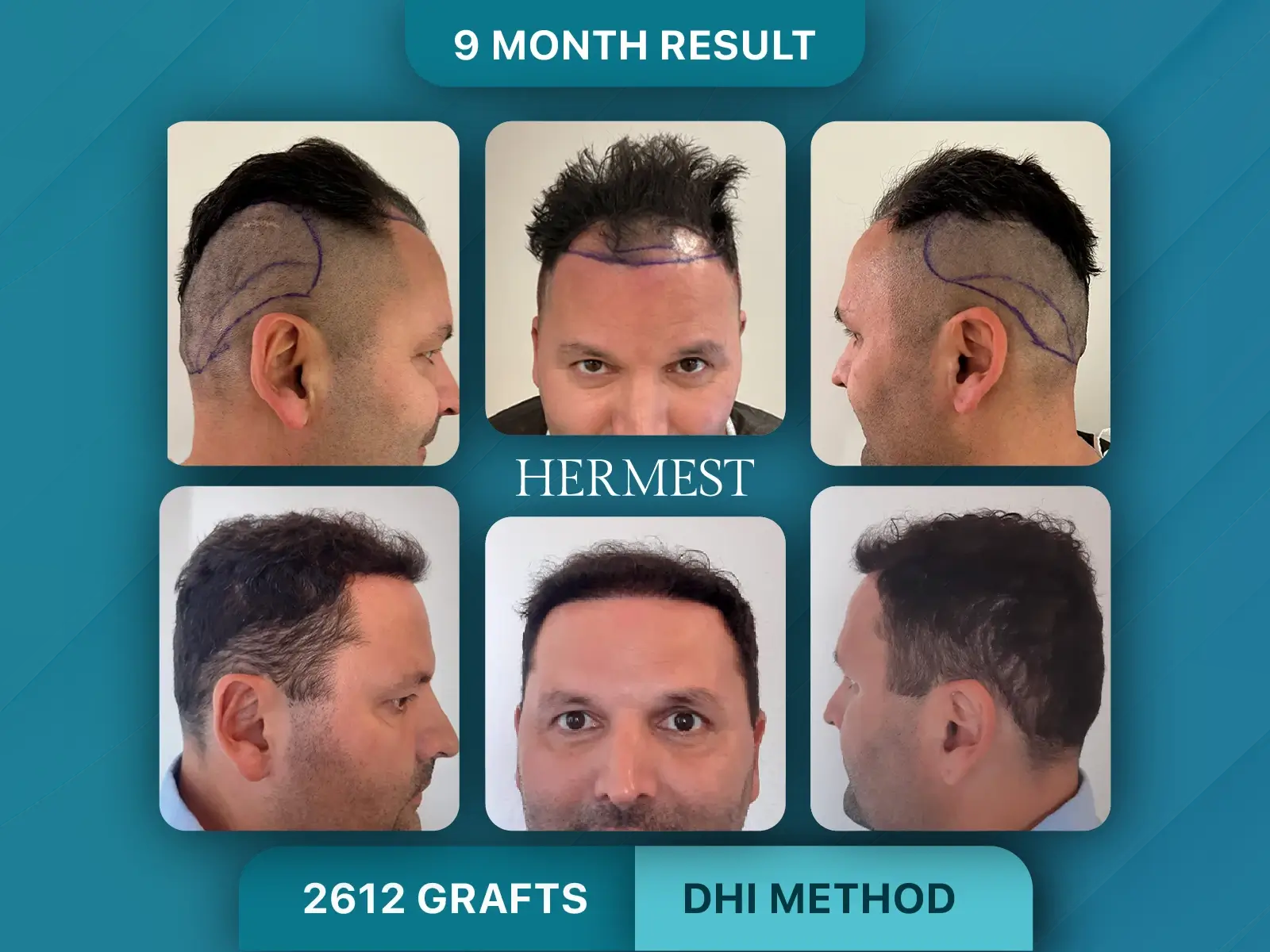 Hair Transplant Before After 2612 Graft