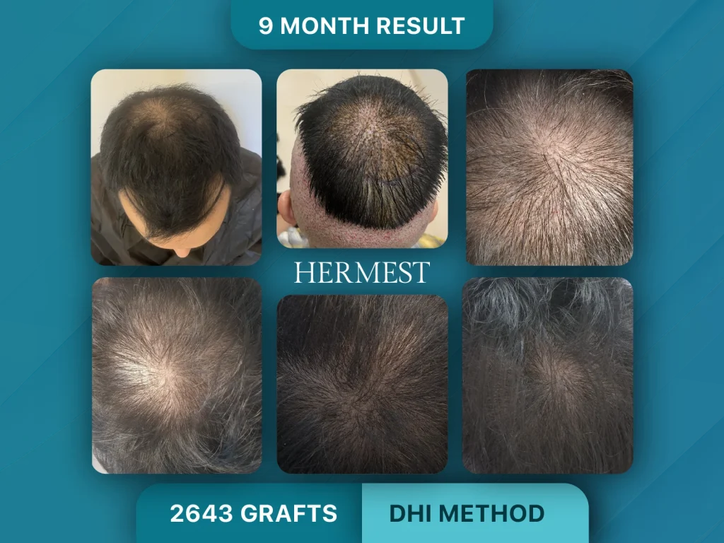 Hair Transplant Before After 2643 Grafts