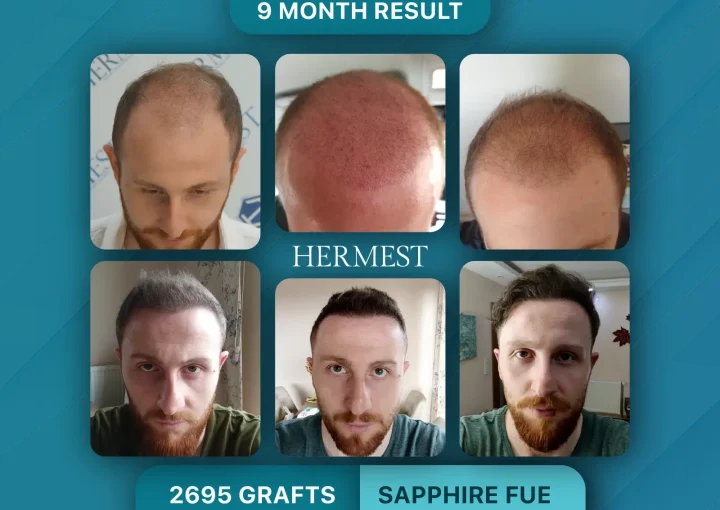Hair Transplant Before After 2695 Graft