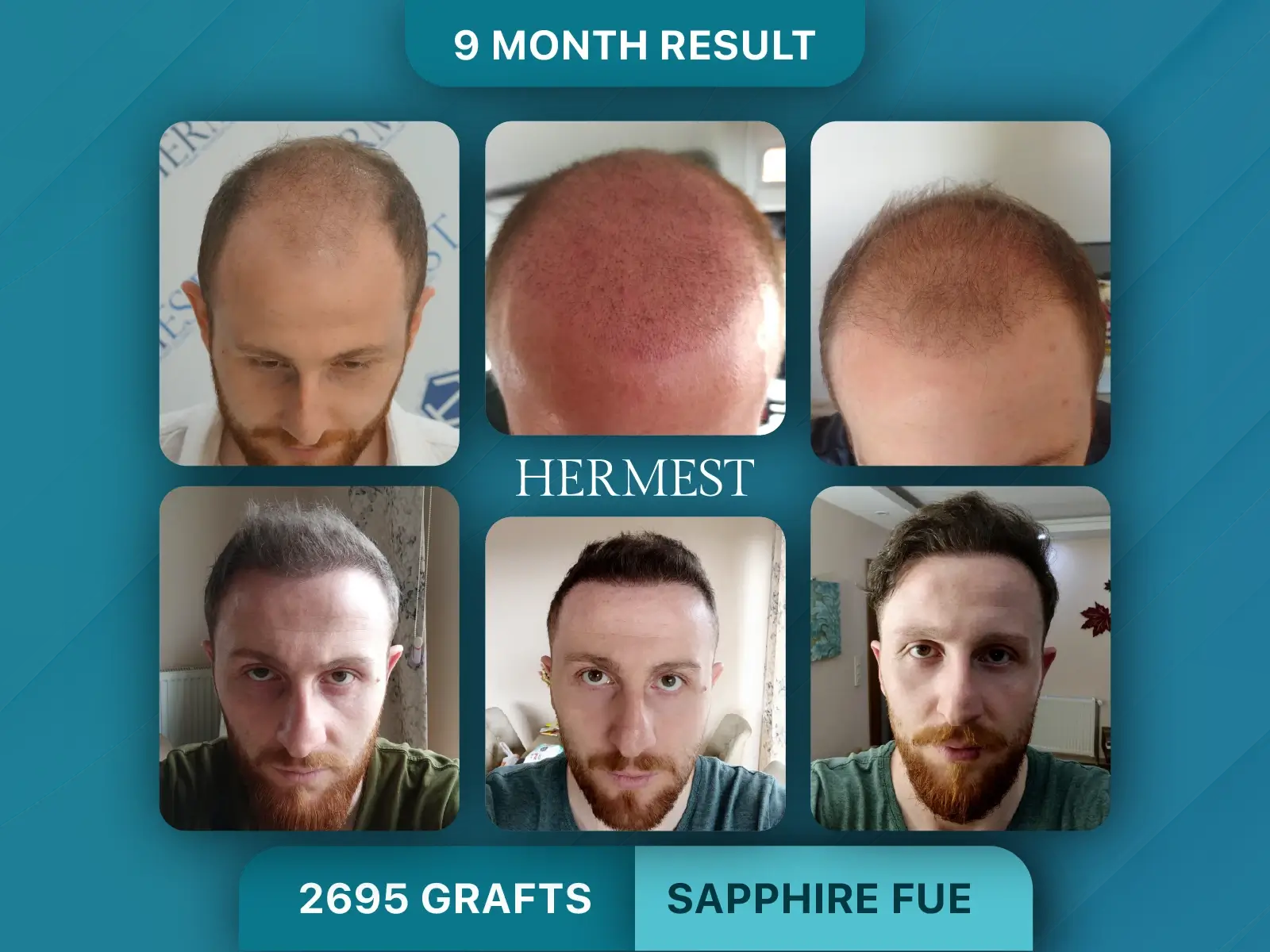 Hair Transplant Before After 2695 Graft