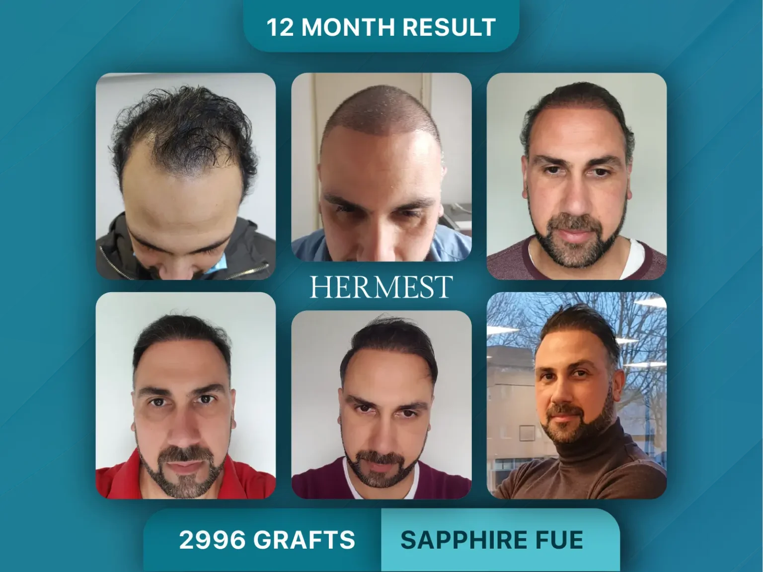 Hair Transplant Before After 2996 Graft