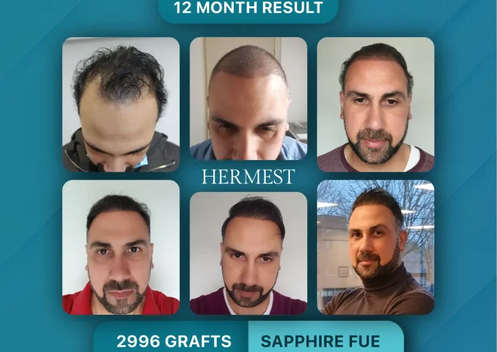 Hair Transplant Before After 2996 Graft