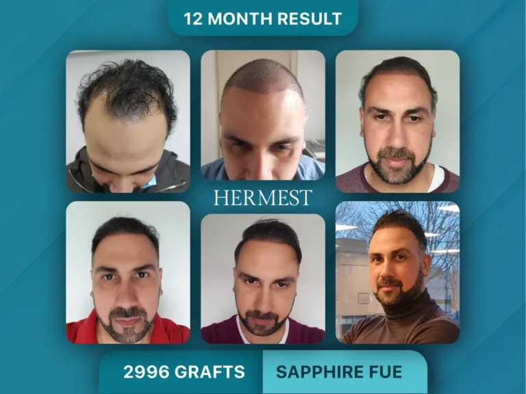 Hair Transplant Before After 2996 Graft
