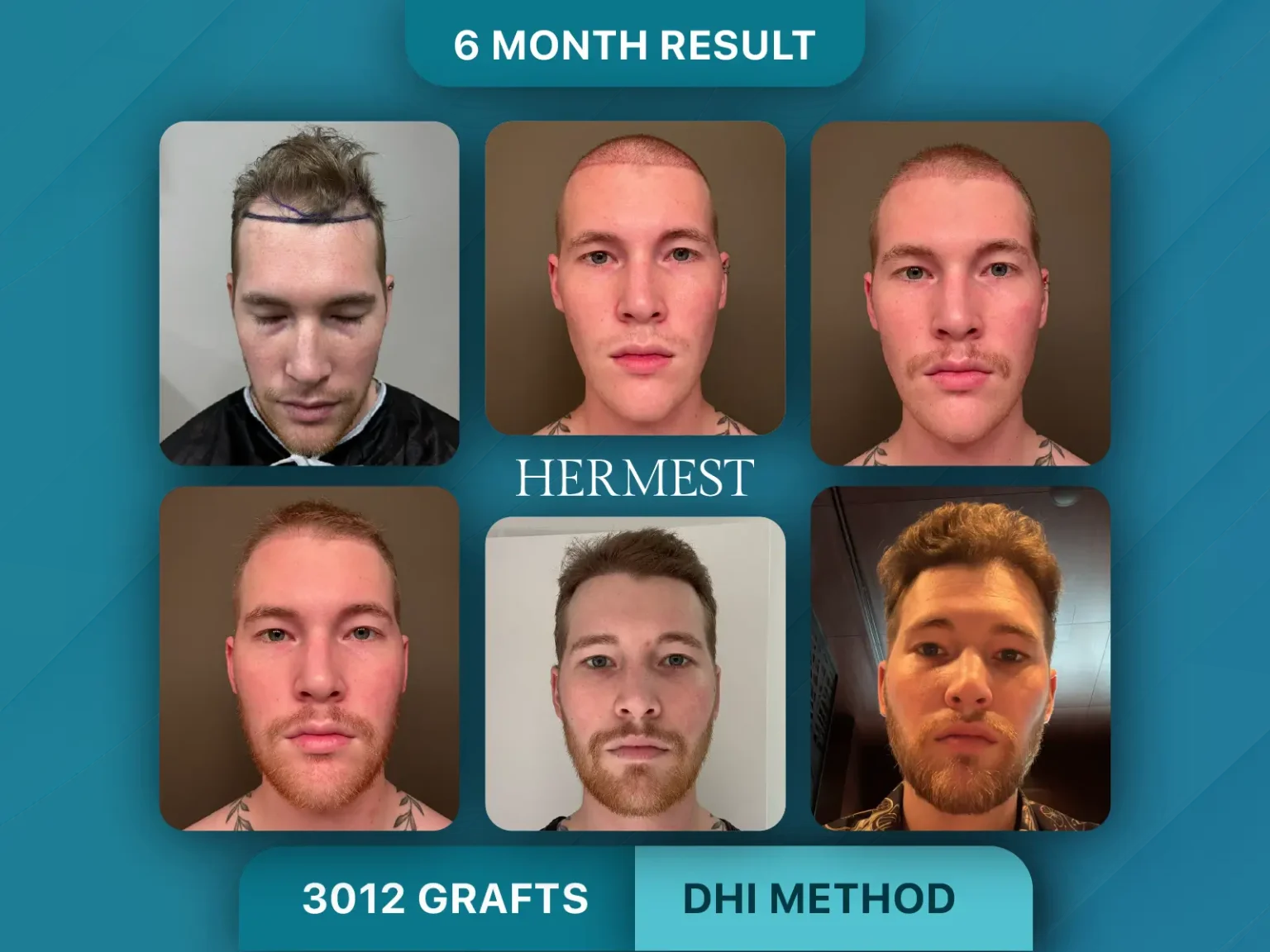 Hair Transplant Before After 3012 Graft