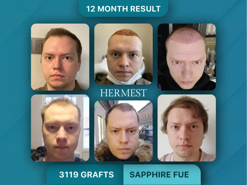 Hair Transplant Before After 3119 Graft