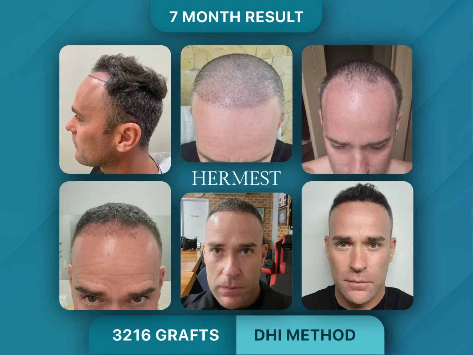Hair Transplant Before After 3216 Graft
