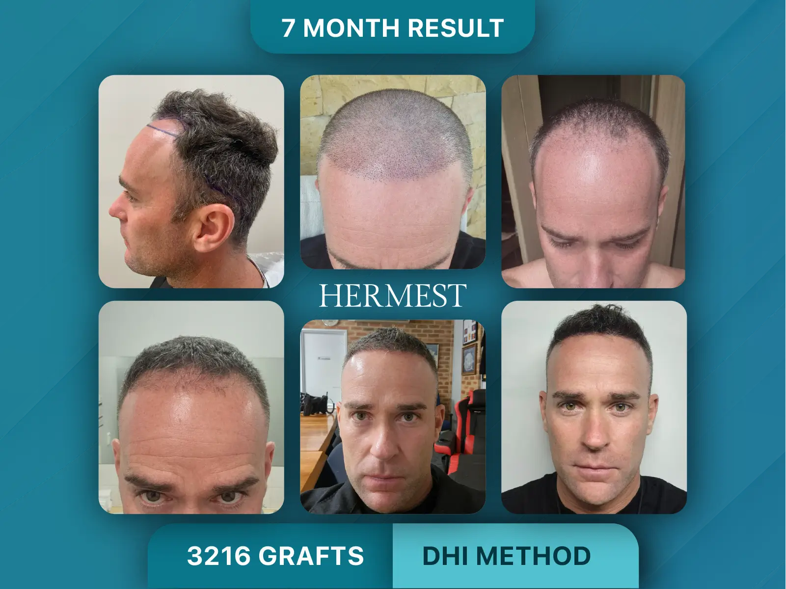 DHI hair transplant before and after, 7-month result: man, hairline and top, 3216 grafts