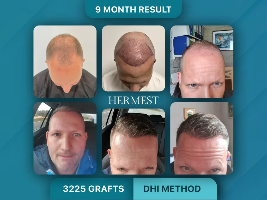 Hair Transplant Before After 3225 Graft