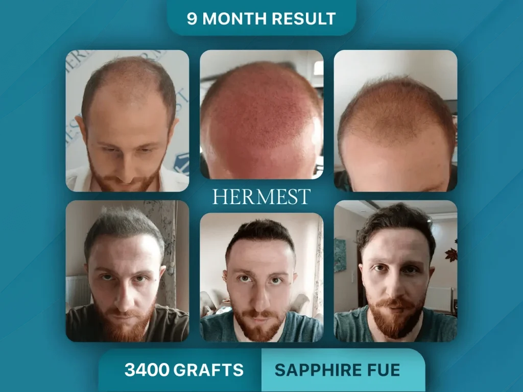 Hair Transplant Before After 3400 Grafts