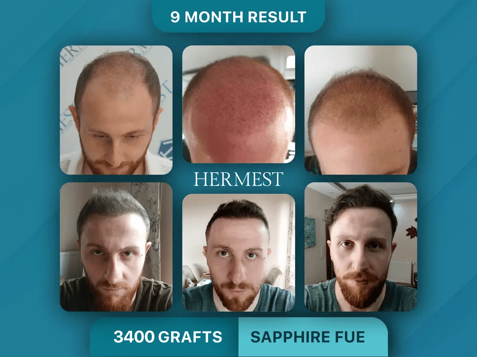 Hair Transplant Before After 3400 Grafts