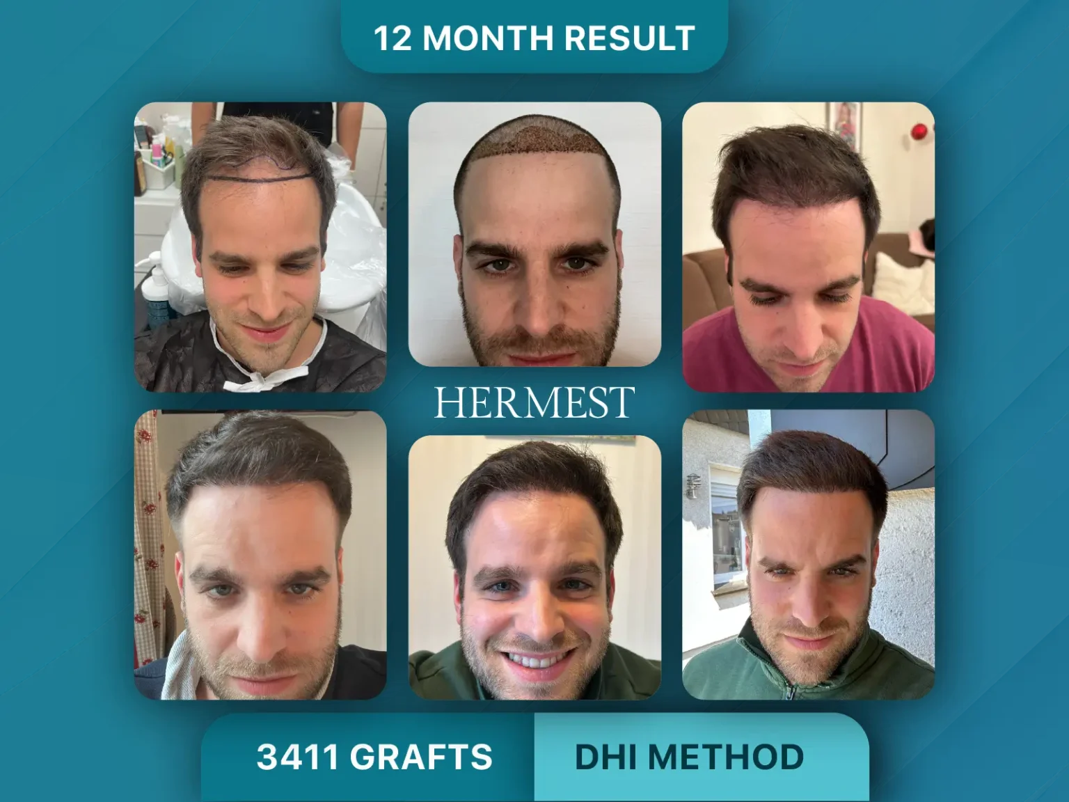 Hair Transplant Before After 3411 Graft