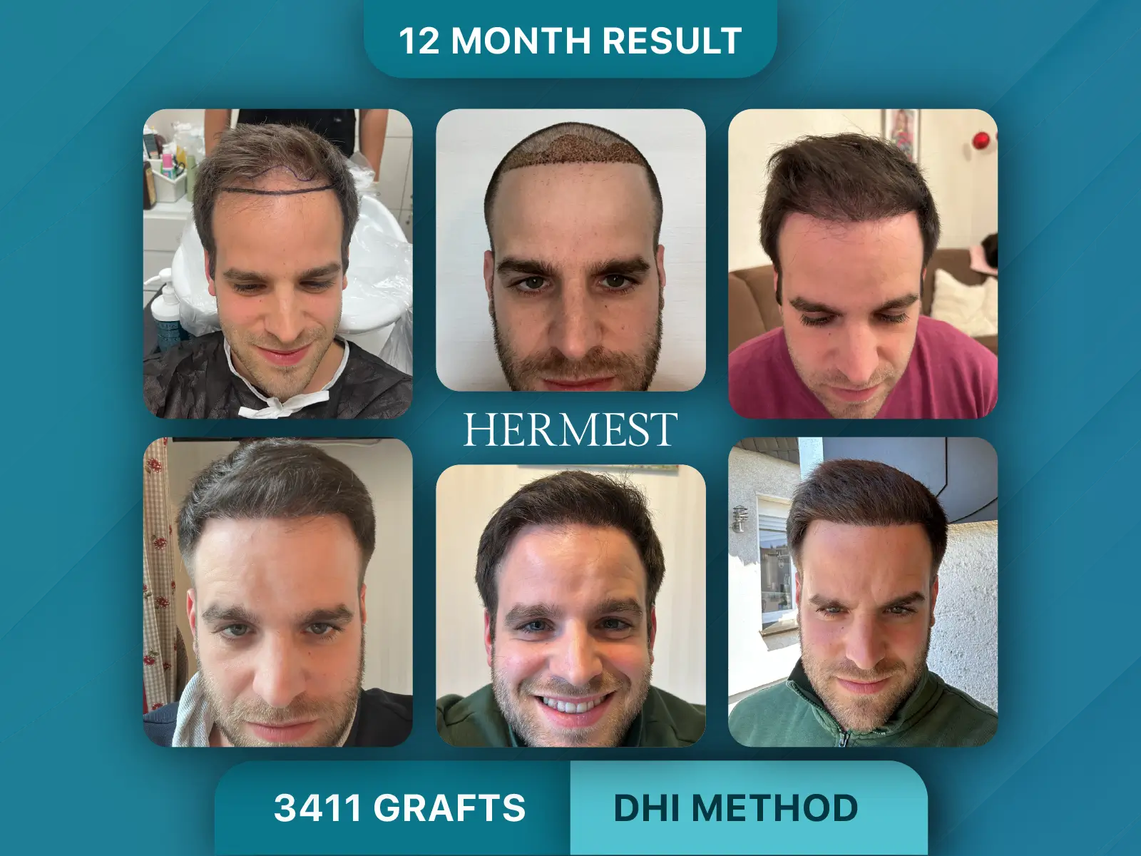 Hair Transplant Before After 3411 Graft