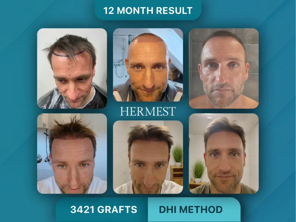 Trapianto di capelli prima e dopo, Metodo DHI – 3421 innesti