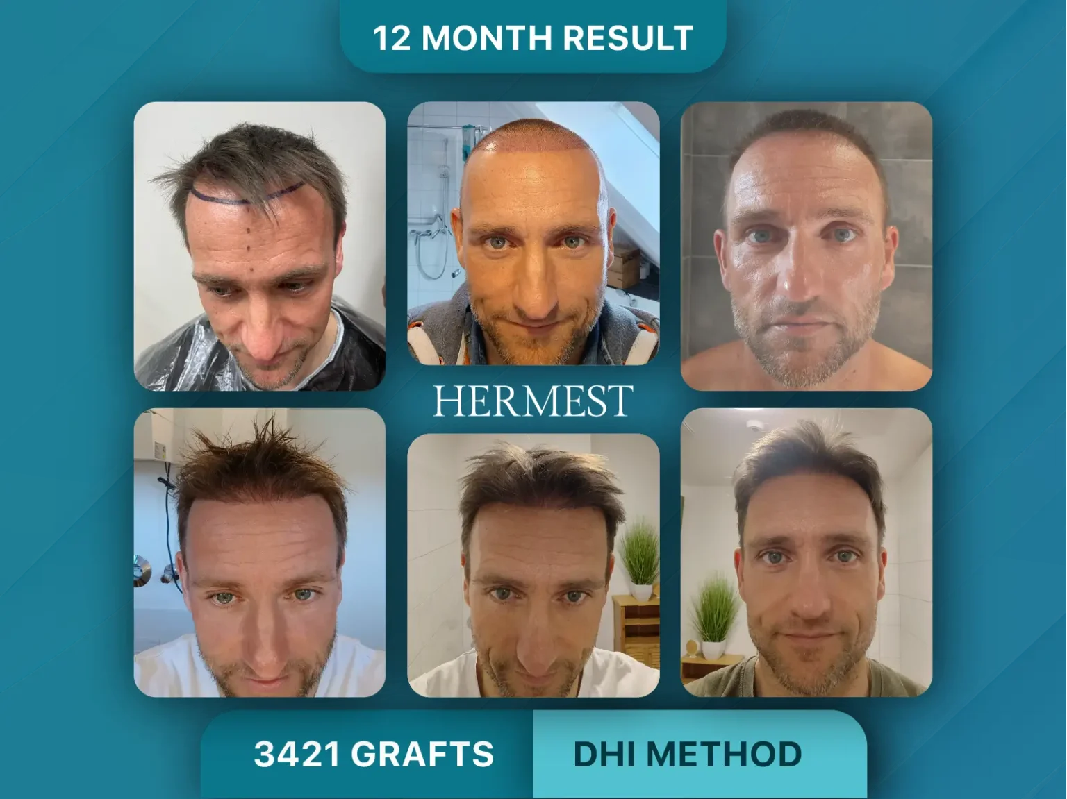 Hair Transplant Before After 3421 Graft