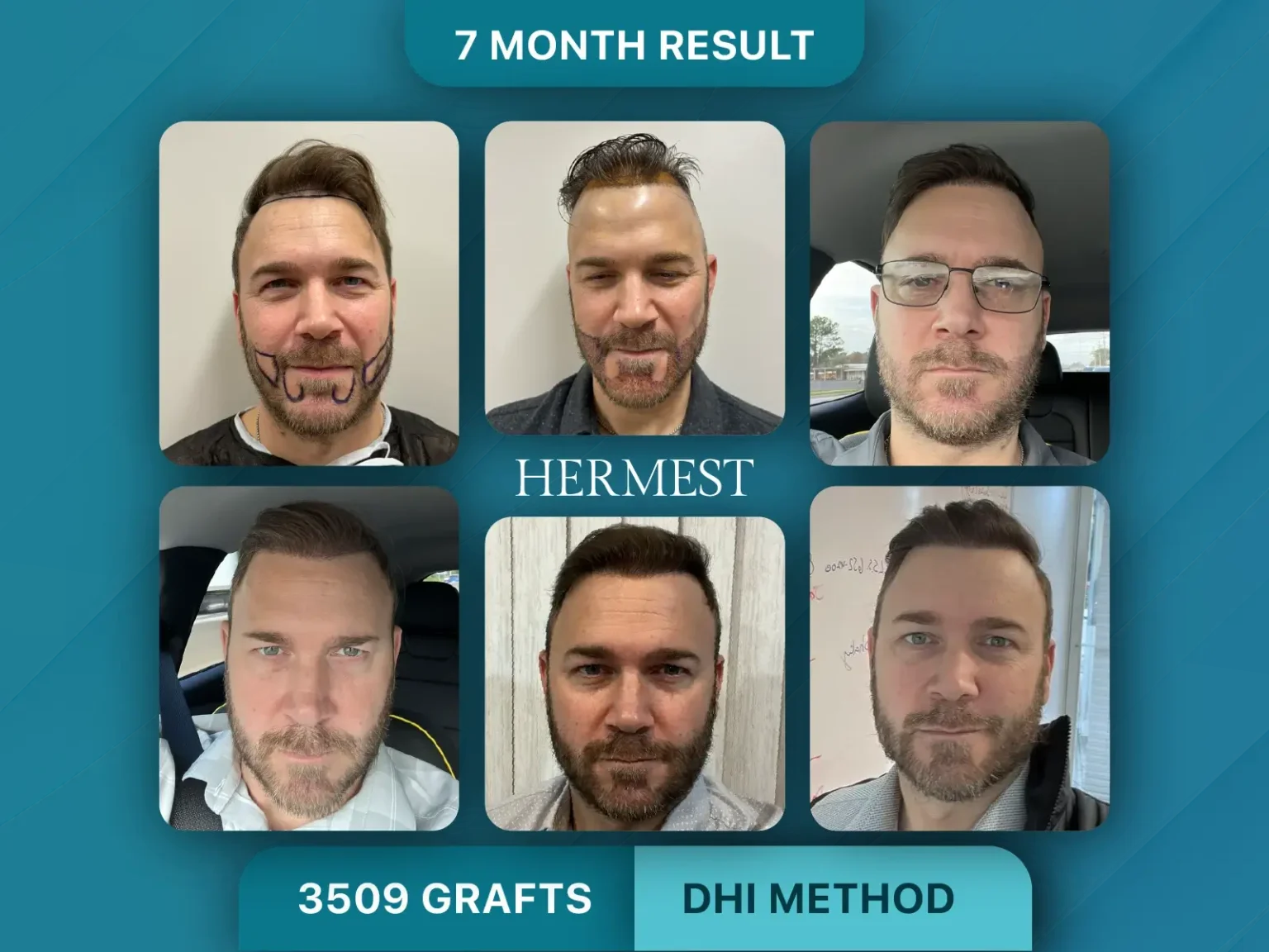 Hair Transplant Before After 3509 Graft