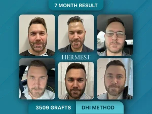 DHI vs FUE Hair Transplant: Which Is Better? 4 Hair Transplant Before After 3509 Graft