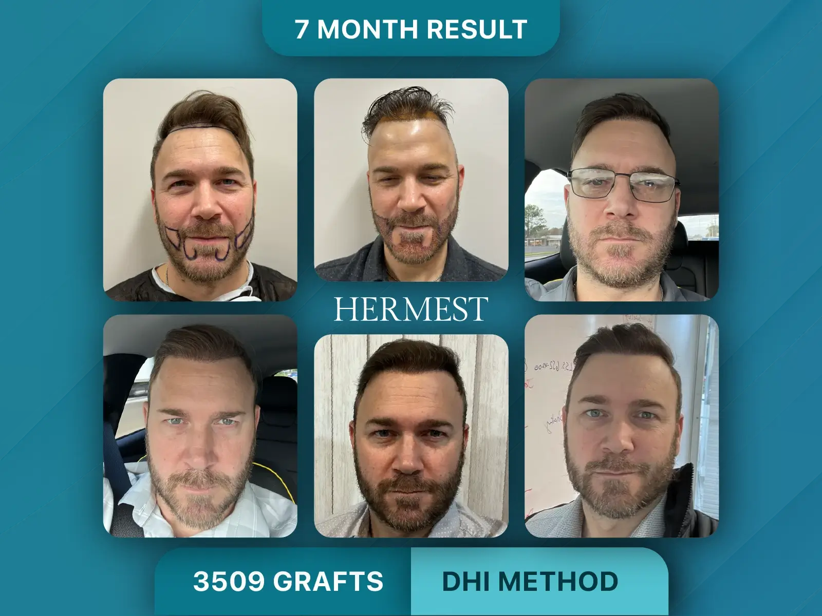 Hair transplant before and after at Hermest: 3509 grafts with the DHI method, 7-month result