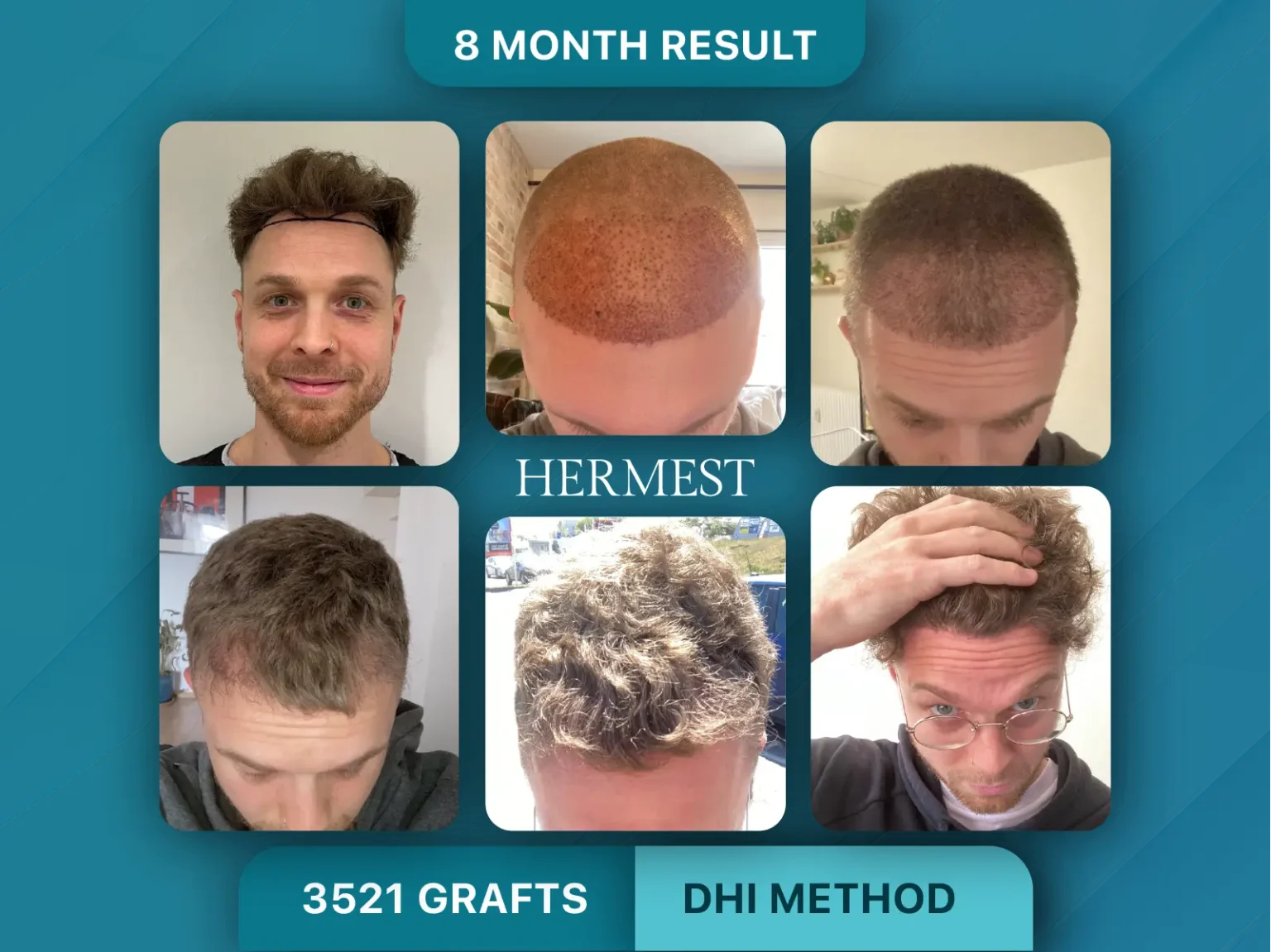 Hair Transplant Before After 3521 Graft