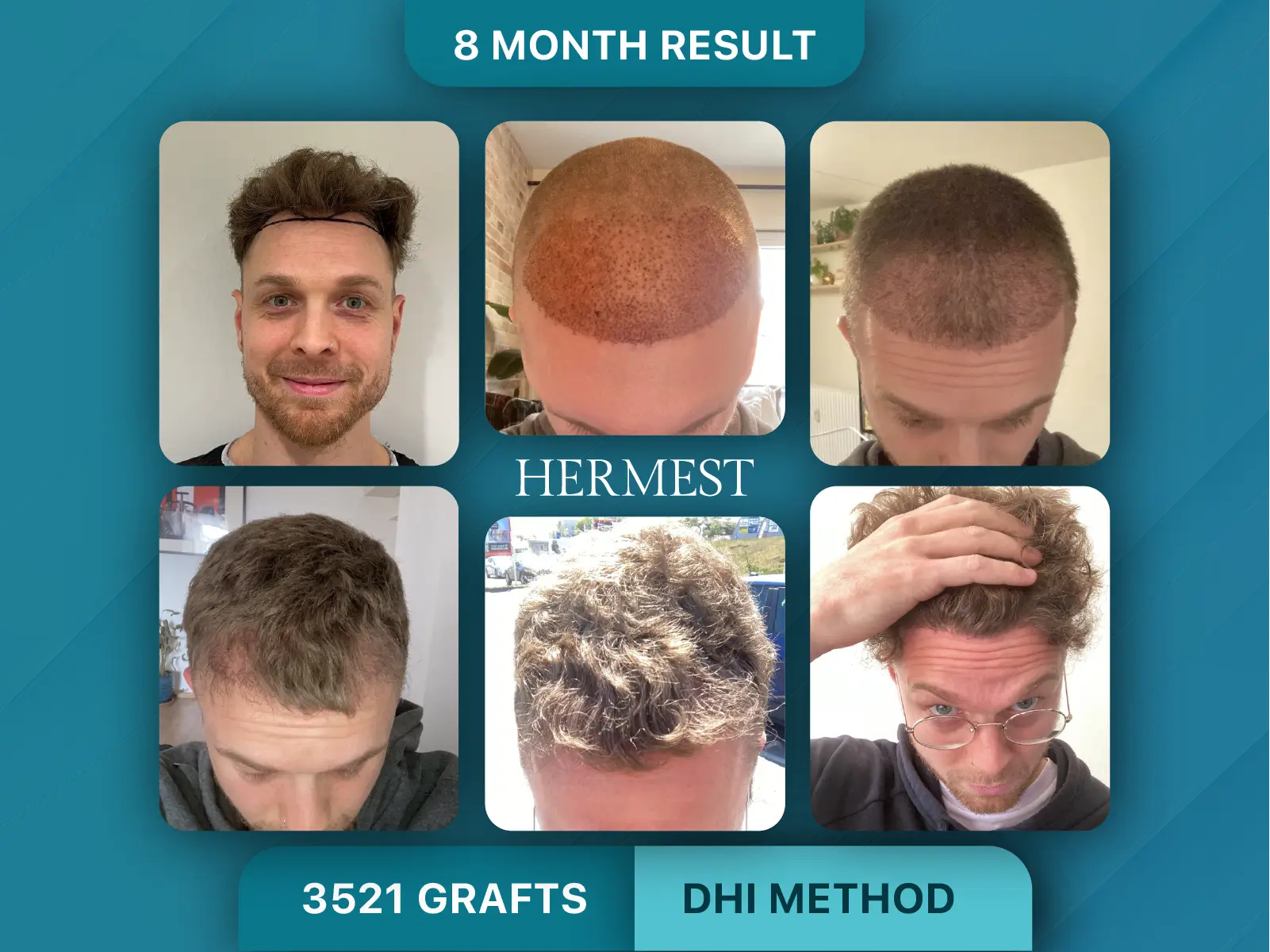 Hair Transplant Before After 3521 Graft