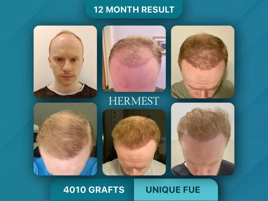 Hair Transplant Before After 4010 Graft