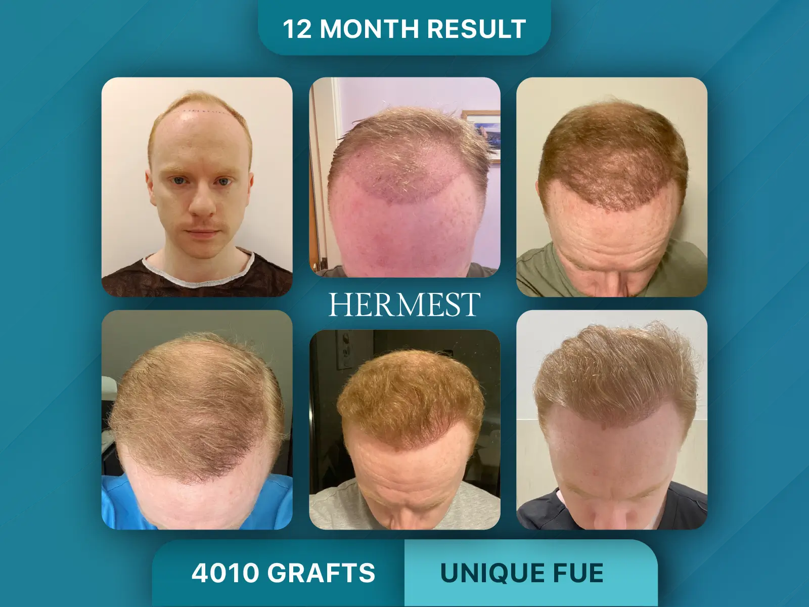 Am I a Good Candidate for Hair Transplant? Complete Eligibility Guide 6 Hair Transplant Before After 4010 Graft