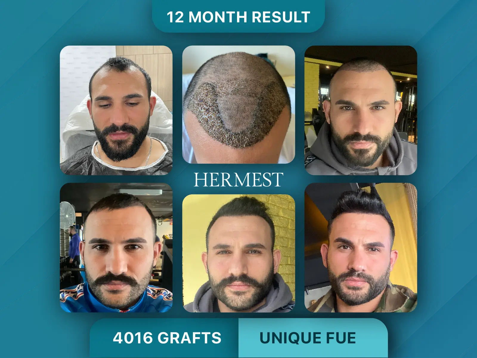 Unique FUE hair transplant before and after, 12-month result: bearded man, top of the head, 4016 grafts
