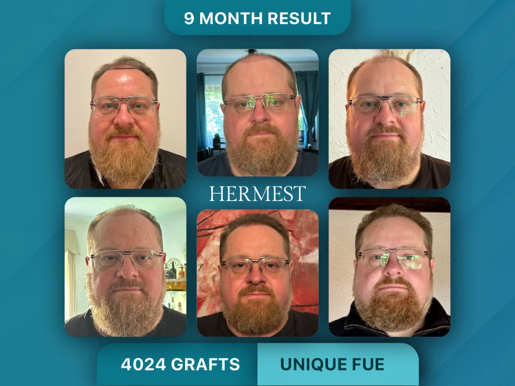 Hair Transplant Before After 4024 Grafts